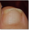 Onychomycosis segmentation project thumbnail