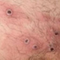 mpox project thumbnail