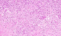 Liver tumor classification project thumbnail