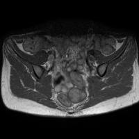 sacroiliitis-t1 project thumbnail