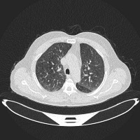 5A_LUNG_CANCER project thumbnail