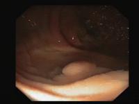 Polyp-cvc clinic project thumbnail