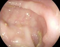 polyp-etis project thumbnail