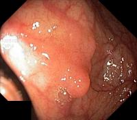 polyp-Kvasir project thumbnail