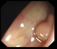 Colorectal cancer detection project thumbnail