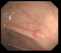 colon enhanced project thumbnail
