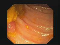 Polyp detection project thumbnail
