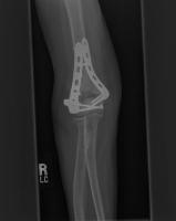 Bone fracture project thumbnail