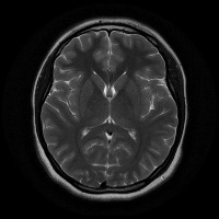 brain Tumor project thumbnail