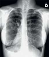 xray classifier project thumbnail