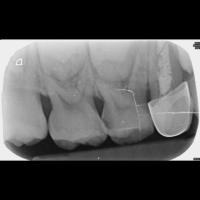 caries_root_123 project thumbnail