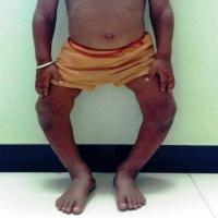 leg_deformities project thumbnail