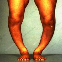 leg detection project thumbnail