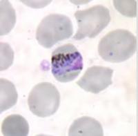 malaria project thumbnail