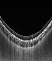 choroid project thumbnail