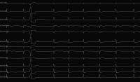 PVC-ECG-Thesis project thumbnail