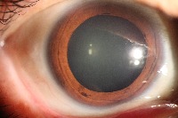 Pterygium_classification project thumbnail
