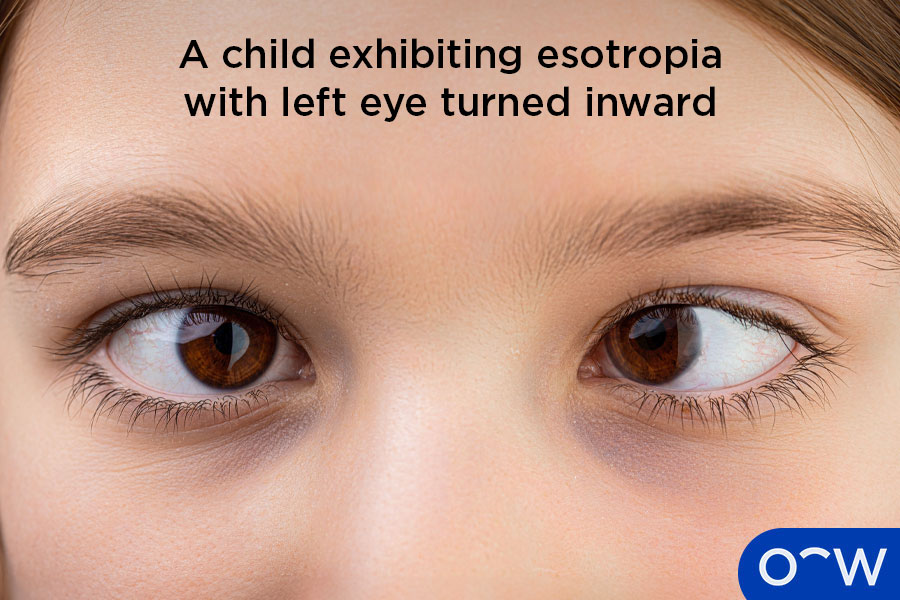 unspecified esotropia icd 10