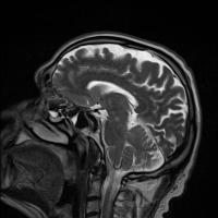 Find brains and Object detection for parkinsons project thumbnail