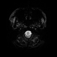 Parkinson Disease project thumbnail