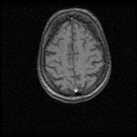 Parkinson project thumbnail