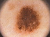 Melanoma_Classification project thumbnail