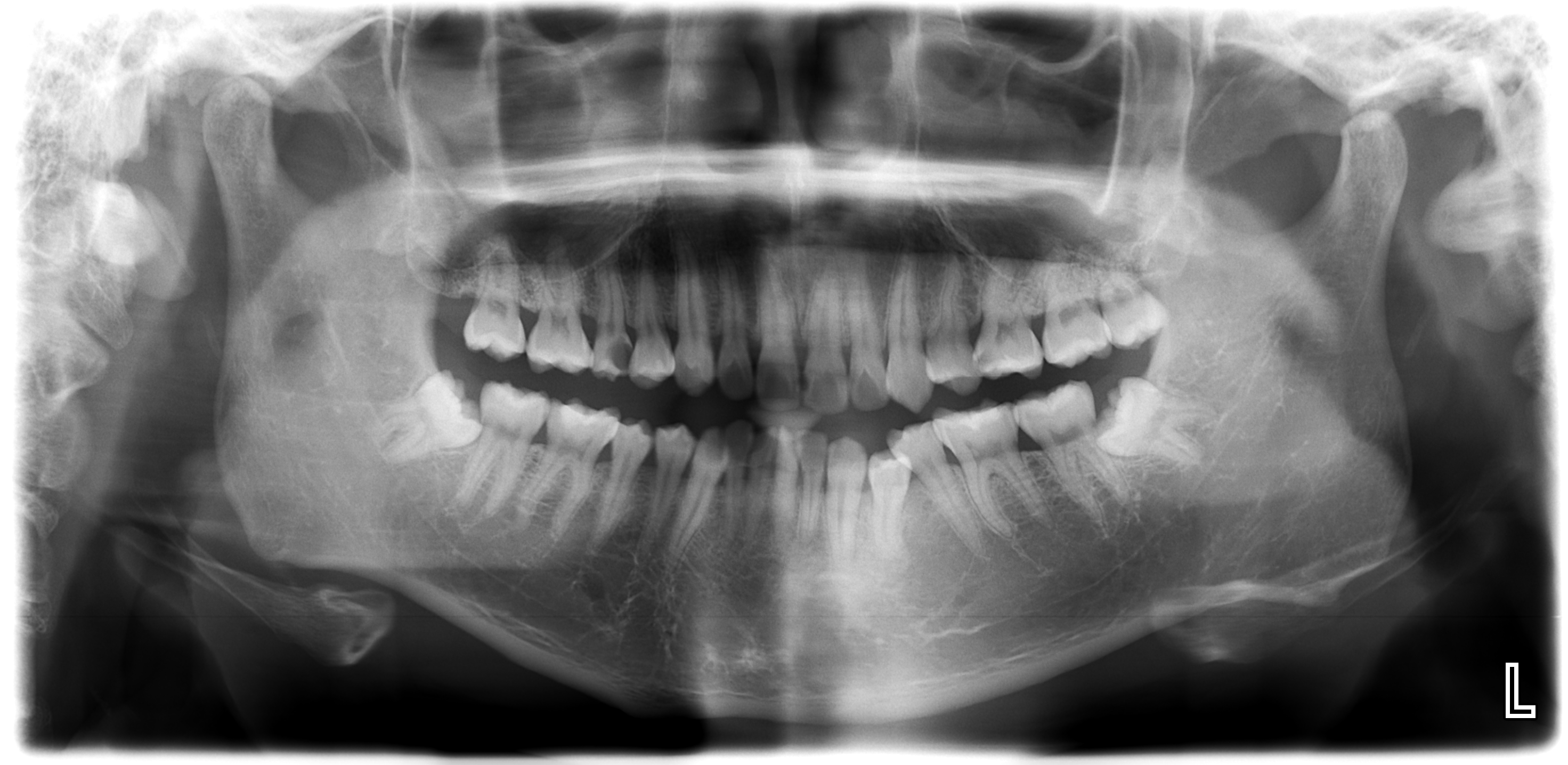 Dental Caries Detection using DL Object Detection Dataset (v1, 202403