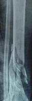 Tibia Shaft Dataset project thumbnail