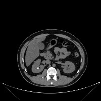 Kidney Stone project thumbnail