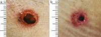 wound type project thumbnail