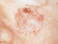 skin cancer project thumbnail