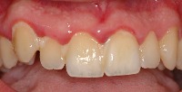 gingivitis detected project thumbnail