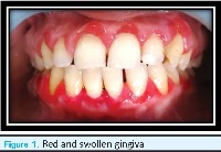 Gingivitis n DentalCaries project thumbnail
