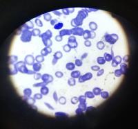 Sickle cell project thumbnail