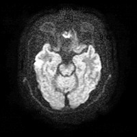 mri stroke classification multi project thumbnail