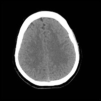 mri stroke segment project thumbnail