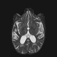 Brain stroke  project thumbnail