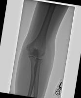 bone fracture project thumbnail