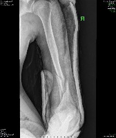 HUMERUS project thumbnail