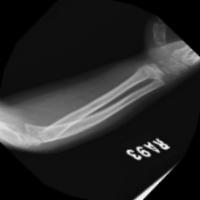 fractured bone project thumbnail