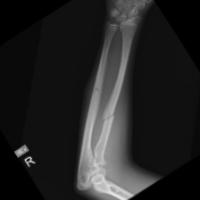 Bone Fracture Detection project thumbnail