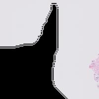 Ovarian Cancer Detection project thumbnail