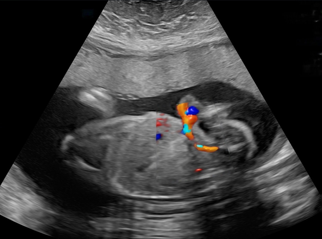 Sagitalabdomcordinsr Instance Segmentation Model by Test