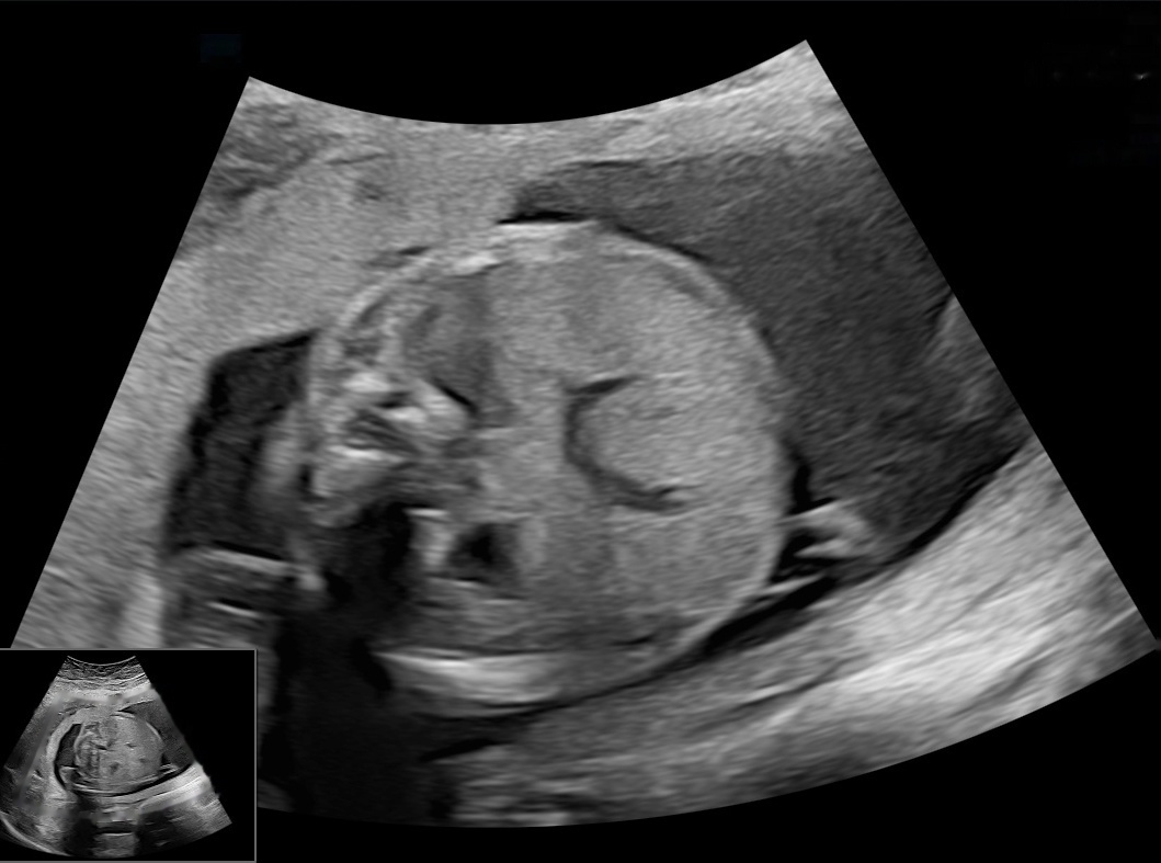 Abdomcirc Instance Segmentation Model by Test