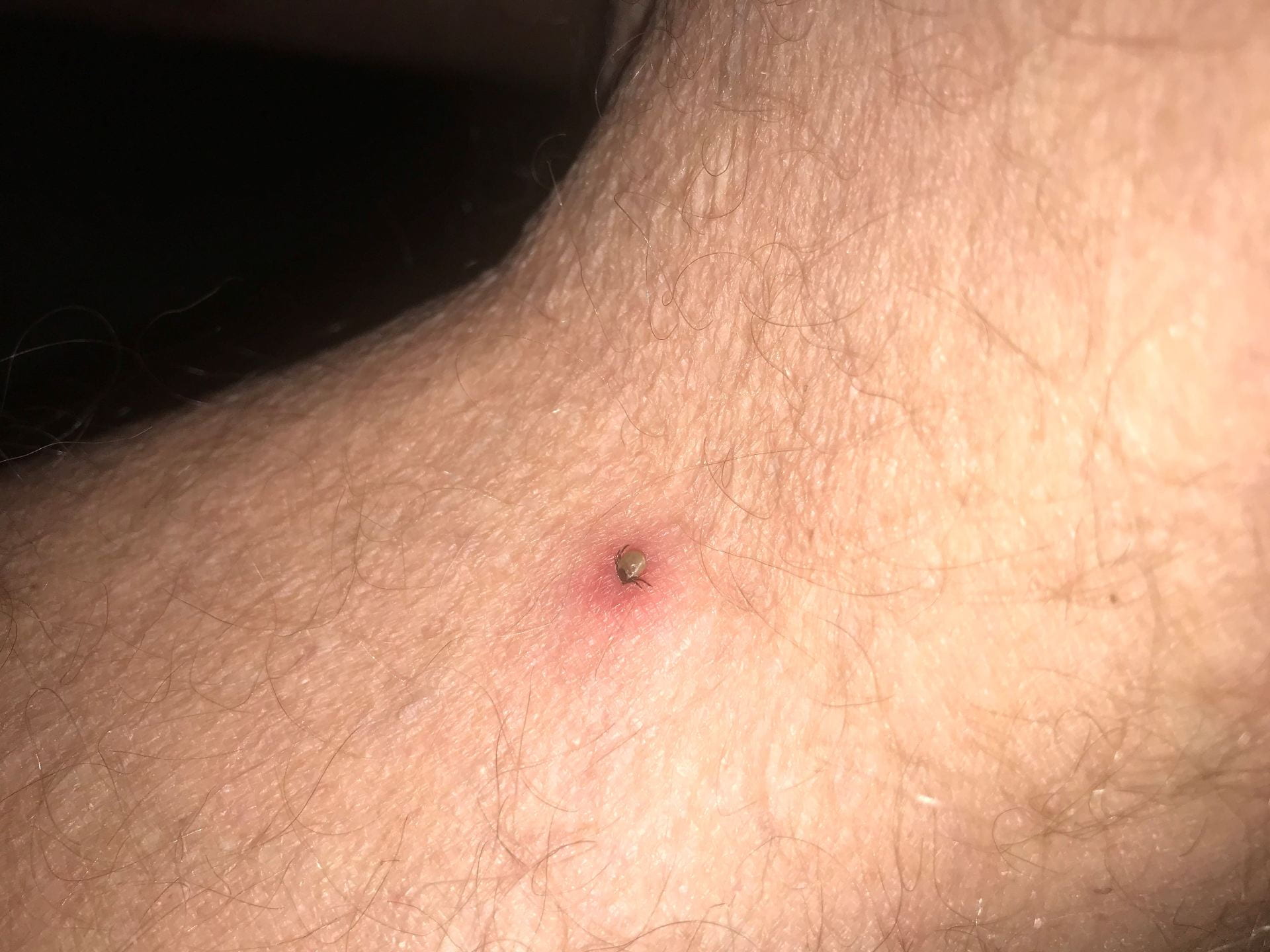 tick still attached