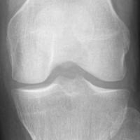 knee_xray_KL project thumbnail