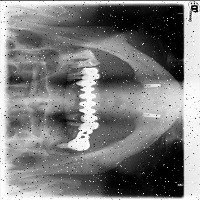 Implant project thumbnail