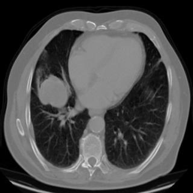 Lung_Cancer_Test Instance Segmentation Dataset by Lungcancerdataset