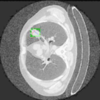 Lung_Cancer_NormAug_Testing project thumbnail
