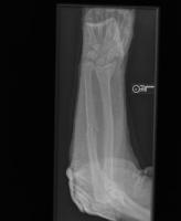 Bone-fracture-kagglehub project thumbnail